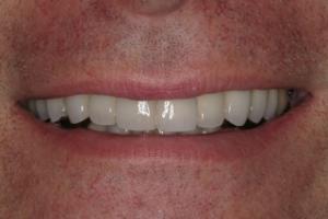 After Ceramic Crowns by Dr. David P. Ney, DDS