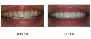 Teeth Whitening at Centre for Smile Designs  - Cosmetic Dentist in Gulfport, MS