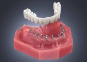 Mini Dental Implant Supported Dentures by Dr. David P. Ney
