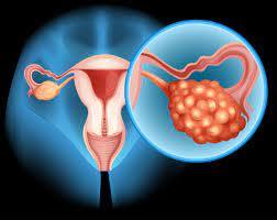 Ovarian Cancer Market