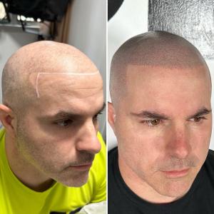 SMP Masters Restores Men’s Self-Confidence by Providing Scalp Micro Pigmentation Services in NY