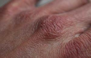 Fish Skin Disease Market