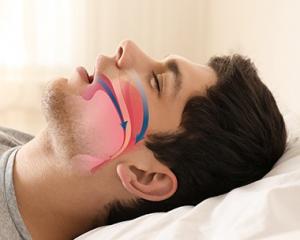 NightLase Snoring Treatments