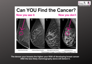 My Density Matters shows mammogram images of cancer in different levels of breast density. Cancer is easily seen in fatty breast density and scattered breast density, it becomes very hard to see in heterogenously dense and extremely dense breast tissue.