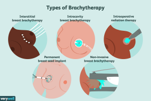 Breast Brachytherapy1