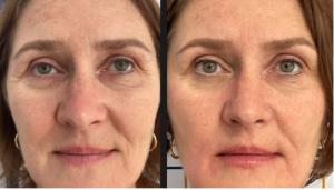 Anti-Aging Facial Skin Treatment Reduces Wrinkles Naturally, Launching Soon in San Mateo Wellness Center