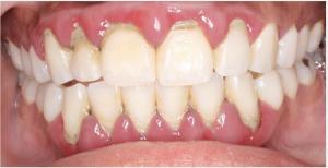 Pretreatment image from 2020 show puffy, swollen, and inflammed gums