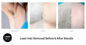 Laser Hair Removal Before & After Results