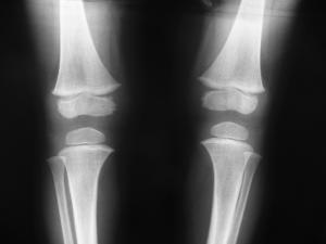 Joint Replacement Market