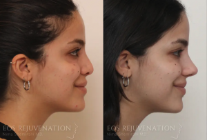 Actual Eos Rejuventation Revision Rhinoplasty Patient