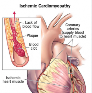 Blockages in the arteries leading to ischemia