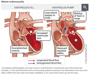 Non-ischemic dilated cardiomyopathy- due to autoimmune, infectious, infiltrative or familial (genetic) causes - results in dilation and ineffectiveness of the heart wall.
