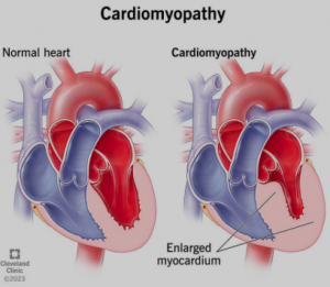 Non Ischemic dilated cardiomyopathy showing enlargement of the heart