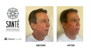 Face and body re-volumization with PRP injectable filler available first at SANTÉ Aesthetics & Wellness in Portland, OR.