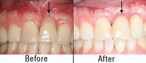 Before & After Gum Grafting Treatment with Dr. Alex Farnoosh