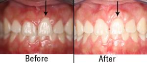 Before & After Gum Grafting with Dr. Alex Farnoosh