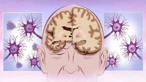 Alzheimer’s Disease Market