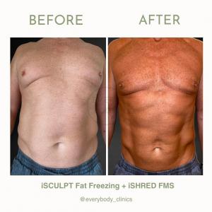 Everybody Clinics Revolutionary Non-Surgical Technology Offers Safe and Effective Fat Removal Alternative