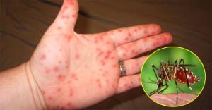 Tropical diseases are returning to the United States and the bugs are bringing them.