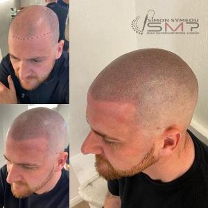scalp micropigmentation before and after london