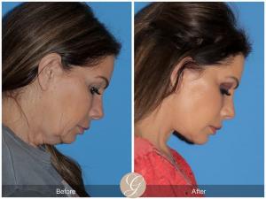 The Superiority of Deep Plane Facelift vs. Traditional Facelift Explained