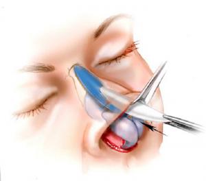 Nasal Implant