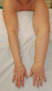 The Role of Various Exercise Modalities in the Treatment of Lymphedema