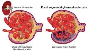 Focal Segmental Glomerulosclerosis Market