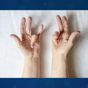 A female patient with severe Dupuytren's contracture in both hands