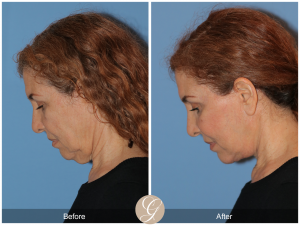 https://drkevinsadati.com/gallery/facelift/deep-plane-facelift/