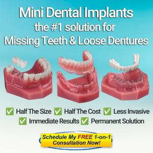 Mini Dental Implant Options - Schedule A Free Consultation