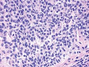 Ewing’s Sarcoma Market to Reach US$ 74.5 Million by 2034