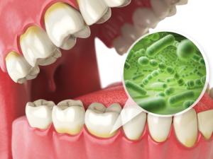Dental-Related Sepsis