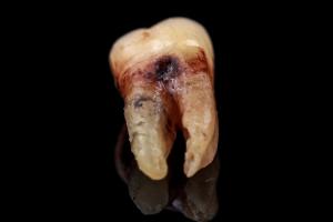 Suboxone film tooth decay lawsuits