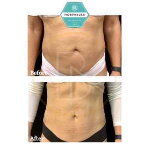 Victoria Corabi - Beauté Aesthetics - Top NYC MedSpa - Before-After MidSection
