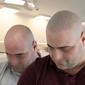 Full 'hair' restoration without surgery on bald man using scalp micro pigmentation