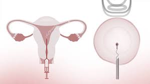 Artificial Insemination Market