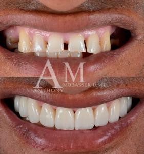 Full-Mouth-Reconstruction-With-Dental-Veneers-in-Los-Angeles