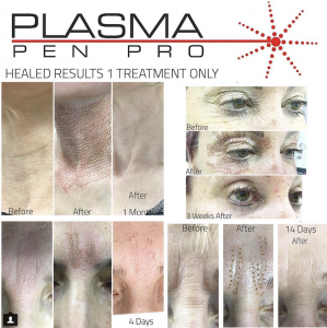 Plasma Pen Pro Eyelid Lift Before and After Results