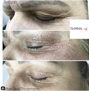 Eyebrow and Eyelid Lift Before and After by Plamere Plasma Pen Pro (PPP)