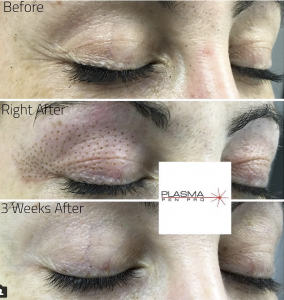 Plasma Pen eyelid lift and upper eye lid  lift by rose cruz