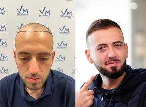 Transforming Looks: Hair Transplantation Emerges as the Top Cosmetic Procedure for Men