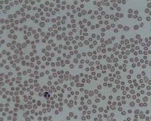 Thrombocytopenia Market Size To Reach Us$ 5.2 Billion By 2034