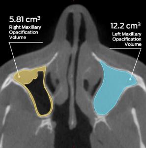 CT image of the left and right maxillary sinuses with the opacification volumes highlighted and measured, 5.81 cubic centimeters on the right, 12.2 cubic centimeters on the left.