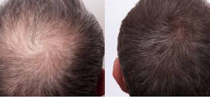 New Breakthrough in Hair Regrowth With Exosomes and PRP Treatment Combined