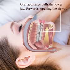 Sleep Apnea Oral Appliances Industry