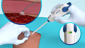 Vascular Closure Devices Market 1