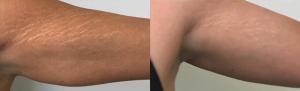 Before and after image showing significant improvement in the appearance of stretch marks on the arm after undergoing the NeuSculpt treatment.