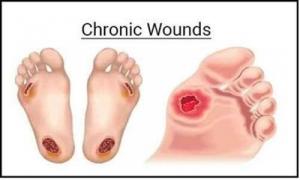 Chronic Wound Management