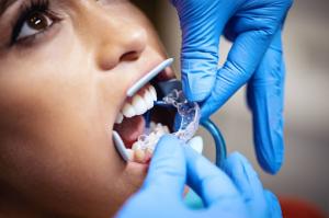 A close-up view of a patient about to be fitted with a clear aligner, showing the dental professional's gloved hands holding the aligner near the patient's open mouth.